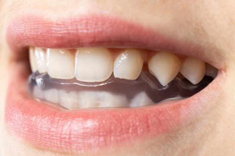 Bruxism-Teeth-Grinding-Treatment https://disadasi.com.tr/wp-content/uploads/2025/08/Bruxism-Teeth-Grinding-Treatment.jpg