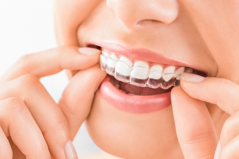 clear -aligners-invisible-orthodontics-turkiye https://disadasi.com.tr/wp-content/uploads/2025/08/clear-aligners-invisible-orthodontics-turkiye.jpg