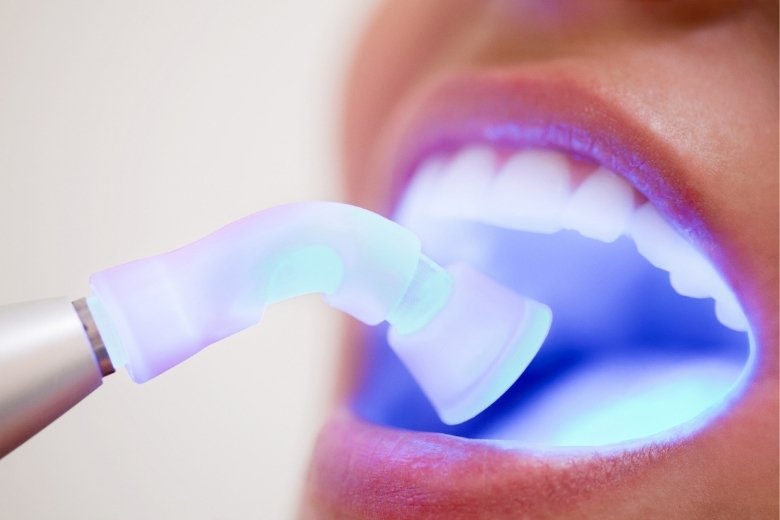 dental-fillings-in-turkiye https://disadasi.com.tr/wp-content/uploads/2025/08/dental-fillings-in-turkiye.jpg