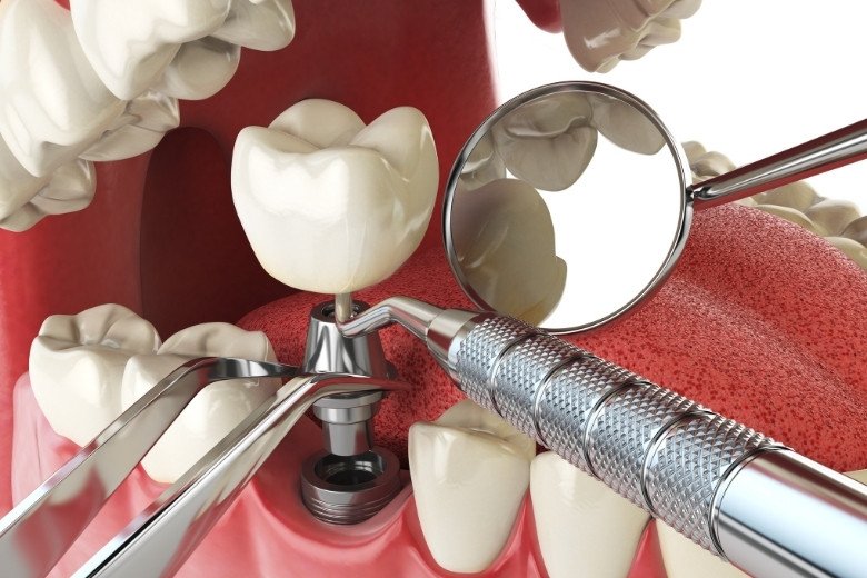 dental-implant-clinic-in-turkey https://disadasi.com.tr/wp-content/uploads/2025/08/dental-implant-clinic-in-turkey.jpg