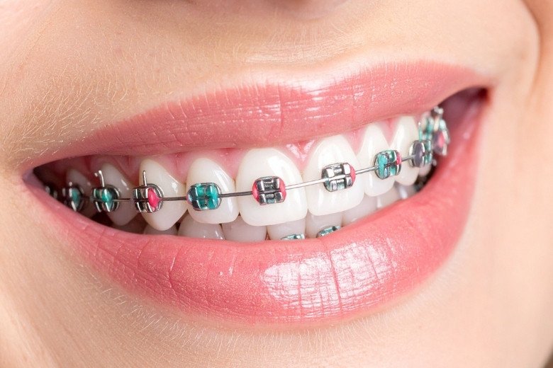 orthodontic-treatment https://disadasi.com.tr/wp-content/uploads/2025/08/orthodontic-treatment.jpg
