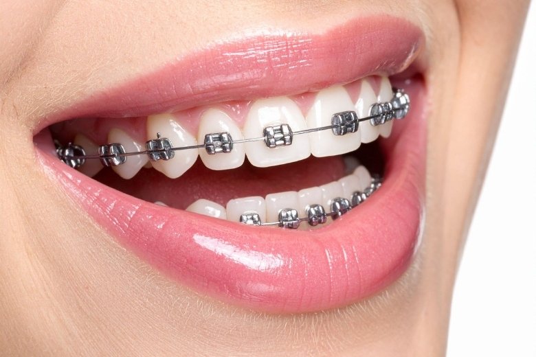 orthodontics-braces-turkiye https://disadasi.com.tr/wp-content/uploads/2025/08/orthodontics-braces-turkiye.jpg