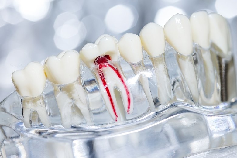 root-canal-tretment https://disadasi.com.tr/wp-content/uploads/2025/08/root-canal-tretment.jpg