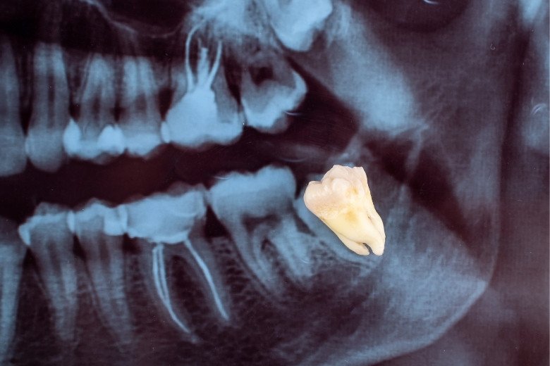 wisdom-tooth-extraction https://disadasi.com.tr/wp-content/uploads/2025/08/wisdom-tooth-extraction.jpg